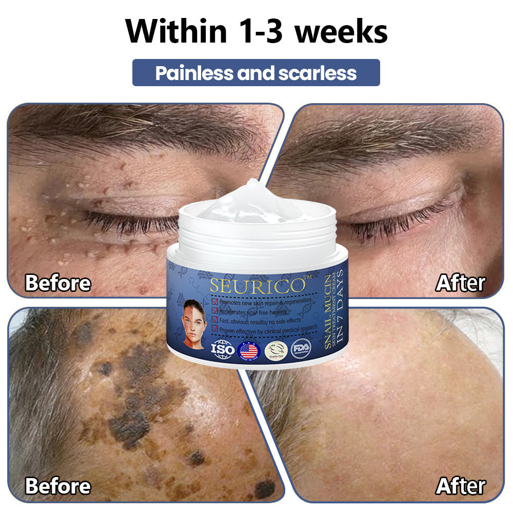 Seurico™ Snail Mucin Skin Treatment Cream (AAD Recommended👨⚕️)💖💟