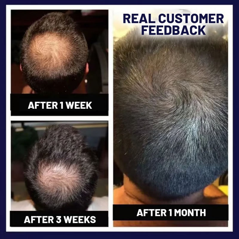 šæ Odeiun⢠Natural Hair Regrowth Spray ā 70% OFF Ends Tonight! š„