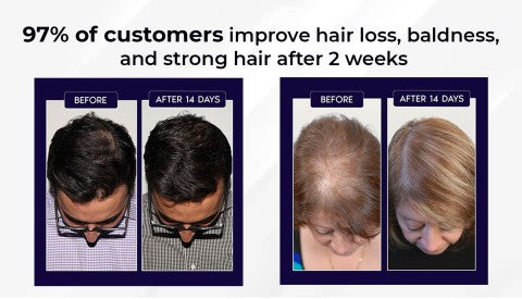 šæ Odeiun⢠Natural Hair Regrowth Spray ā 70% OFF Ends Tonight! š„