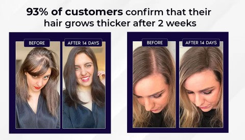 šæ Odeiun⢠Natural Hair Regrowth Spray ā 70% OFF Ends Tonight! š„