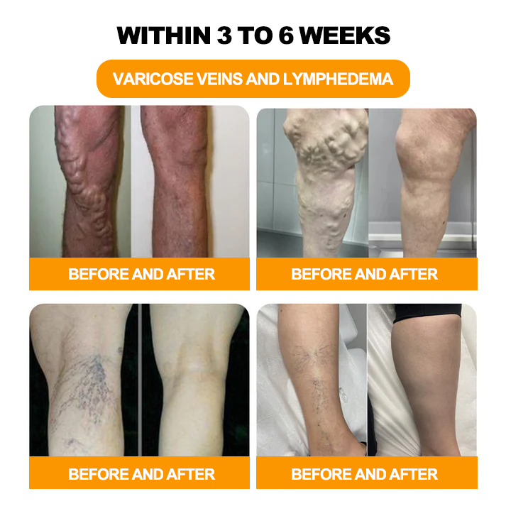 Seurico™ Herbal VenoDetox Foot Bath Beads🌲(𝐋𝐀𝐍𝐀 𝐂𝐞𝐫𝐭𝐢𝐟𝐢𝐜𝐚𝐭𝐢𝐨𝐧，𝗟𝘆𝗺𝗽𝗵𝗮𝘁𝗶𝗰 𝗔𝘀𝘀𝗼𝗰𝗶𝗮𝘁𝗶𝗼𝗻 𝗼𝗳 𝗔𝗺𝗲𝗿𝗶𝗰𝗮)