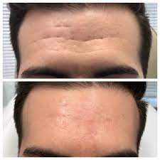 Seurico™™ Power Redo Anti-Aging Blur & Smooth Wrinkle Filler-Last Day Sale 90% OFF 🔥Buy 1 Get 2 Free🔥
